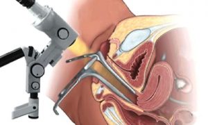Kolposkopi nedir?