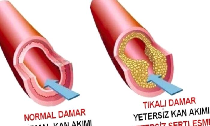KORONER ARTER HASTALIĞI
