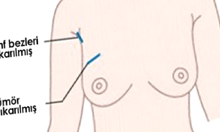 Koruyucu Meme Cerrahisi