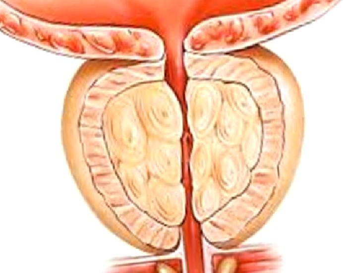 Kronik Prostatit Tanı ve Tedavi