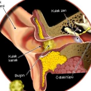 KULAK KİRİ TIKACI: SERUMEN VEYA BUŞON
