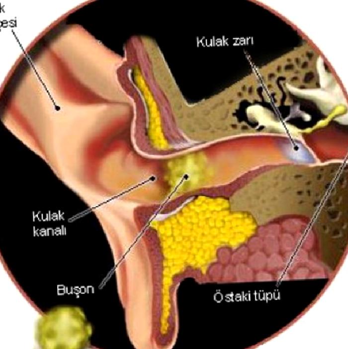 KULAK KİRİ TIKACI: SERUMEN VEYA BUŞON