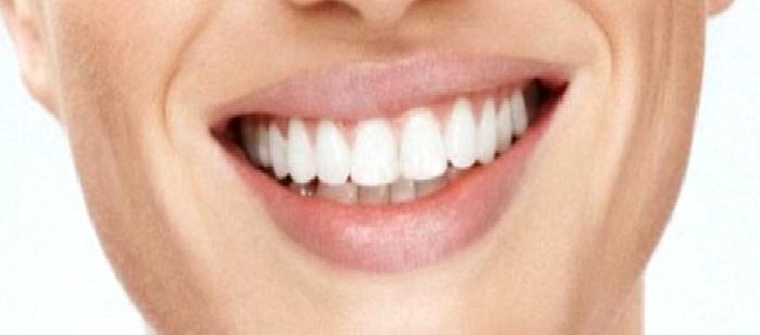 Küretaj Nedir Nasıl Yapılır? Diş Eti tedavisi ve Diş Eti Ameliyatı