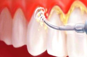 Küretaj Nedir? Nasıl Yapılır?