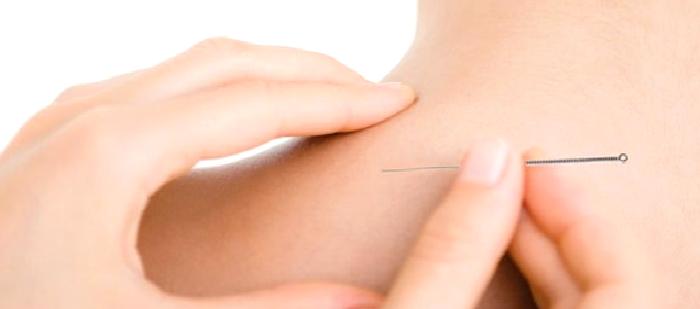 Kuru İğne Tedavisi