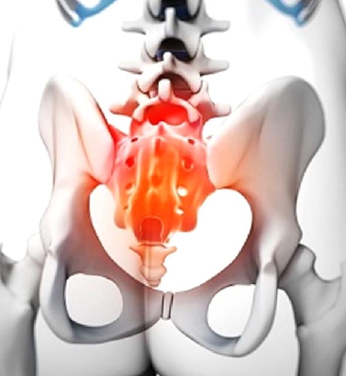 Kuyruk Sokumu Ağrısı