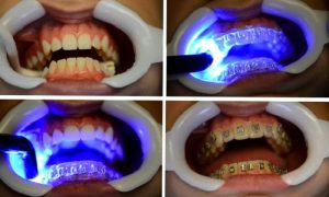 LABORATUVAR ÇALIŞMALARI – İNDİREKT BONDİNG