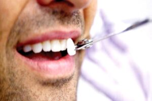 Lamine Veneer Nedir?