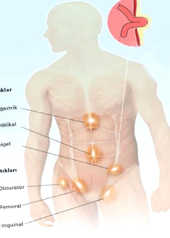 Laparoskopik Fıtık Tedavisi