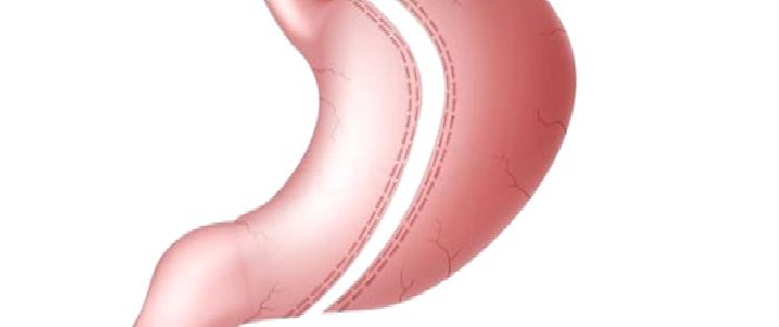 Laparoskopik Sleeve Gastrektomi (Tüp Mide) Ameliyatı Nedir?