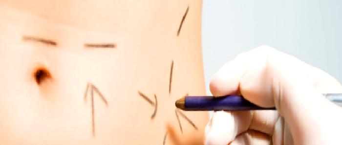 Lazer Liposuction