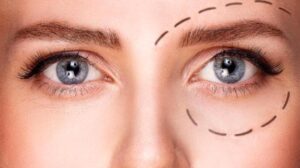 Lazerle Tüm Göz Çevresi Gençleştirme