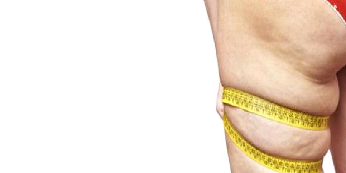 Lipödem Nedir?