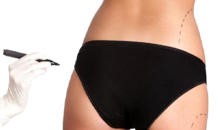 Liposuction