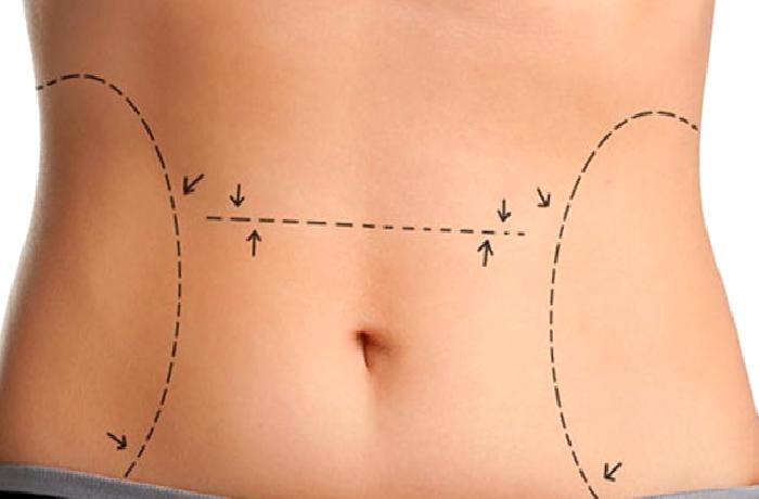LIPOSUCTION