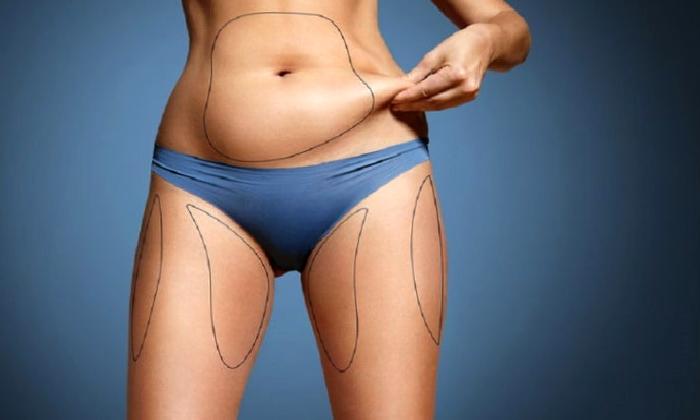 Liposuction