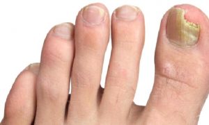 Mantar Hastalığı ve Tedavisi