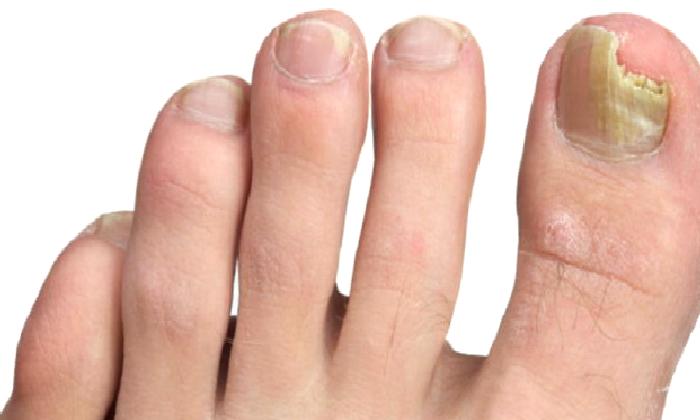 Mantar Hastalığı ve Tedavisi