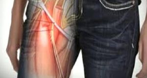 Maralgia Parastetika