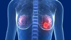 Meme Kanseri Risk Faktörleri