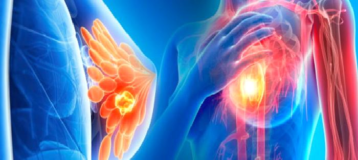 Meme Kanseri Risk Faktörleri