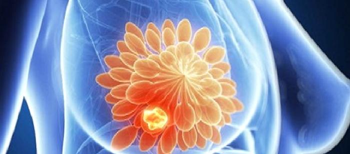 Meme Kanserinde Risk Faktörleri