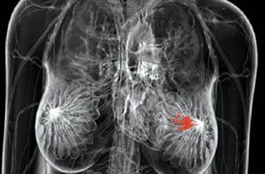 MEME KİTLELERİ VE FİBROKİSTİK HASTALIK