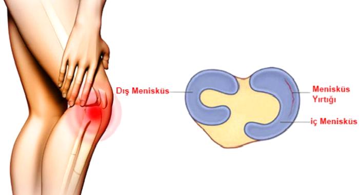 Menisküs Yırtığı