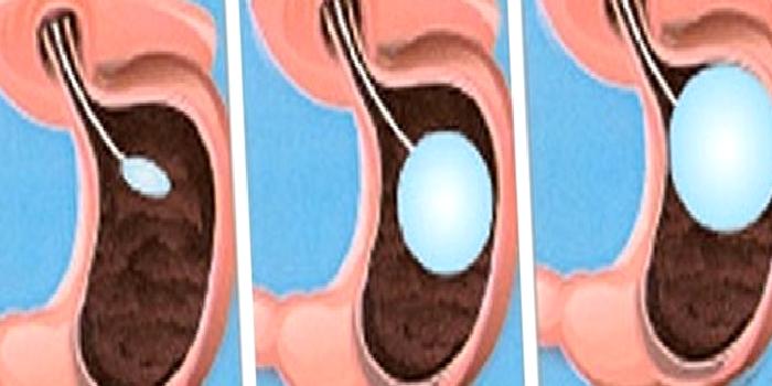 Mide Balonu (Gastric Balloon)