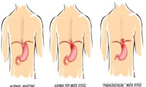 Mide Fıtığı ve Reflü