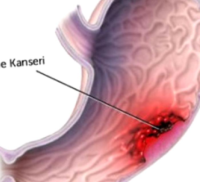 Mide Kanseri