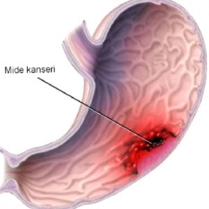 MİDE KANSERİ