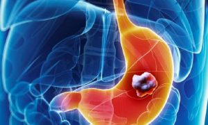 MİDE KANSERİ: TEŞHİS, TEDAVİ, KORUNMA ve BESLENME PRENSİPLERİ