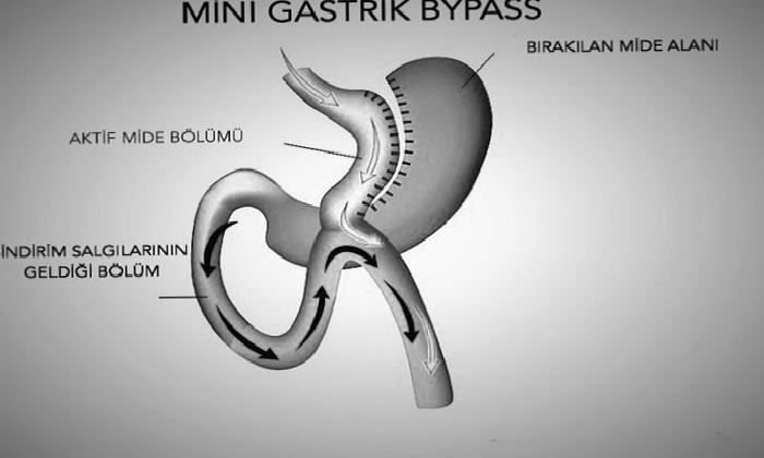 Minigastrik Bypass Ameliyatı