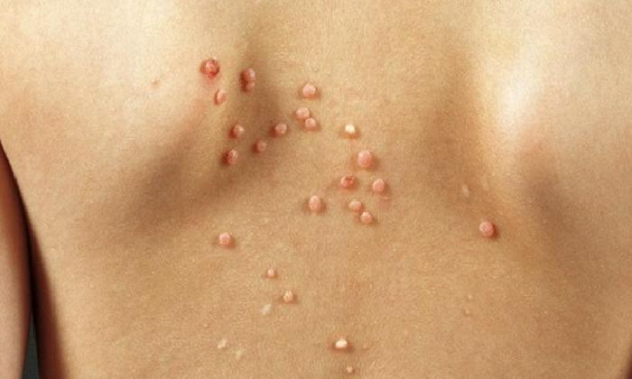 Molluskum kontagiosum (MC)