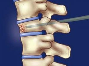 Omurilik Yaralanmaları
