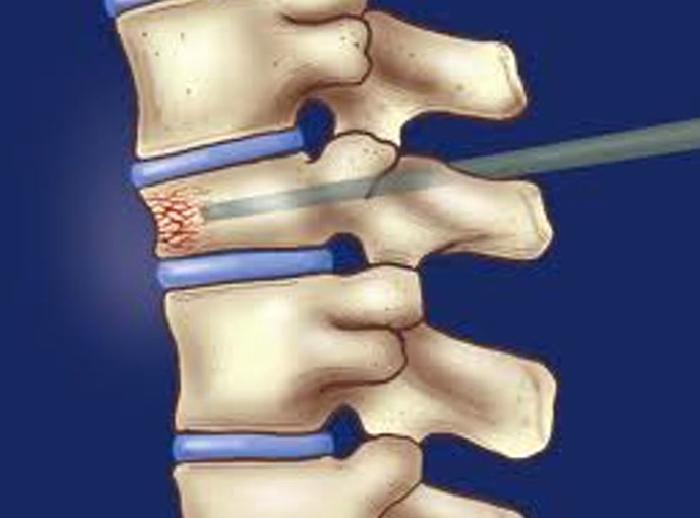 Omurilik Yaralanmaları