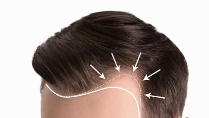 Ön Saç Çizgisi Tasarımı