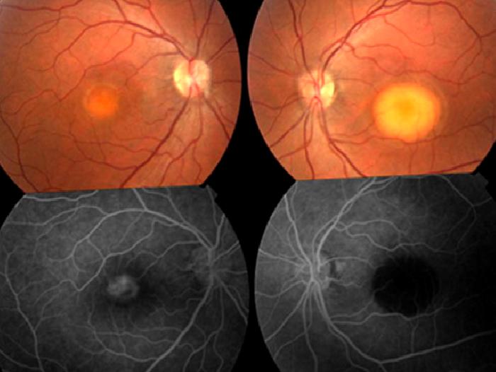 Optik Pit Makülopati