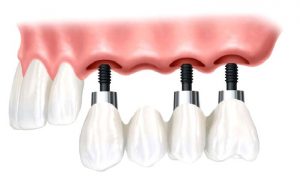 Oral implantoloji