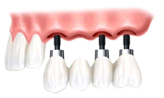 Oral implantoloji