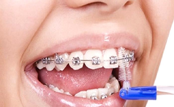 Ortodonti Tedavisi