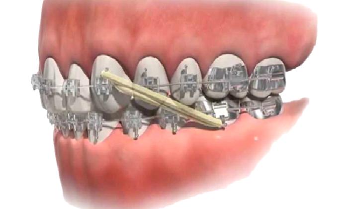 ORTODONTİK TEDAVİYE NE ZAMAN BAŞLANMALI?