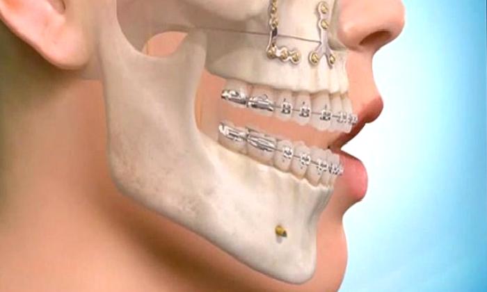 Ortognatik Cerrahi (Cerrahi Ortodonti) Nedir?
