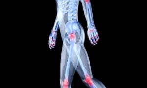 Osteoartrit, Diğer adıyla Kireçlenme..