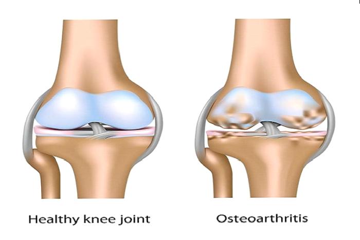 OSTEOARTRİT