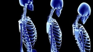 Osteoporoz ve Önemi