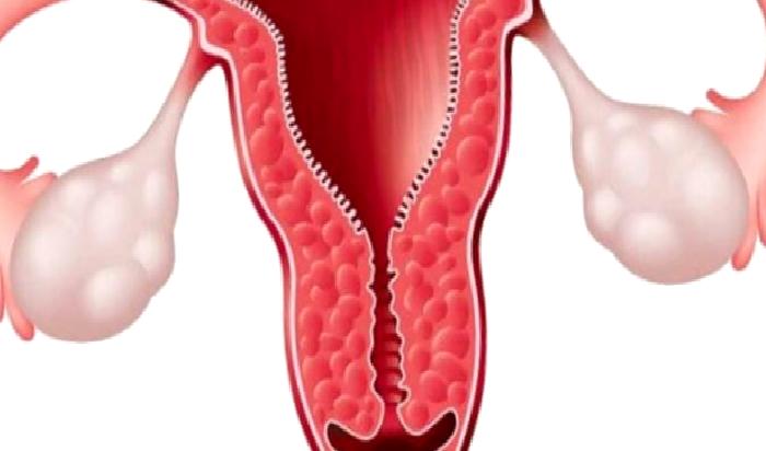 Over Kisti Belirtileri