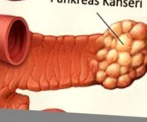 Pankreas Kanseri