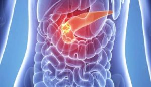 PANKREAS KANSERİ AŞISI MÜMKÜN MÜ?